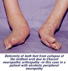 Charcot Joint Knee