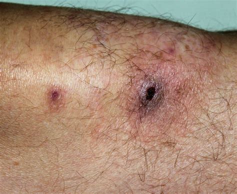 A rash in a patient with neutropenia | The BMJ