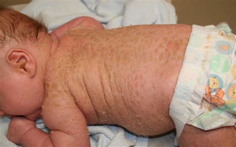 Lamellar Ichthyosis Baby