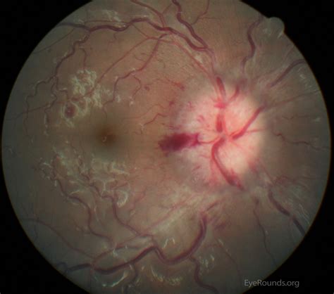 Atlas Entry - Papilledema secondary to Meningitis