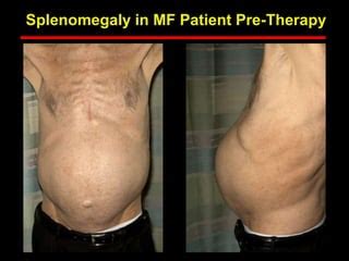 Treatment of High Risk Myelofibrosis.