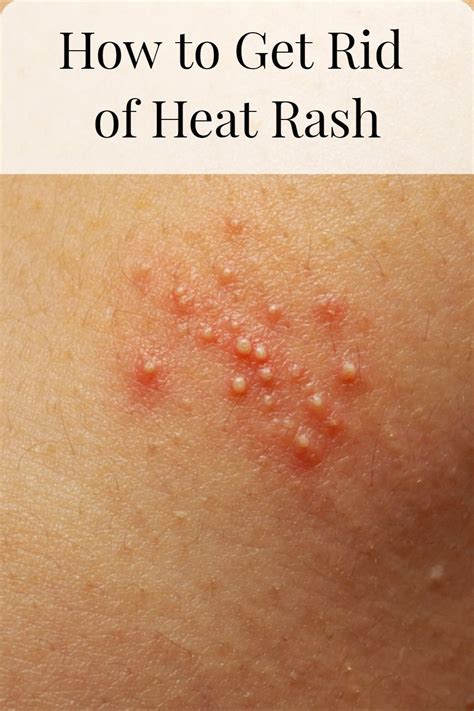 How to Get Rid of Prickly Heat (Heat Rash) | Heat rash, Prickly heat ...