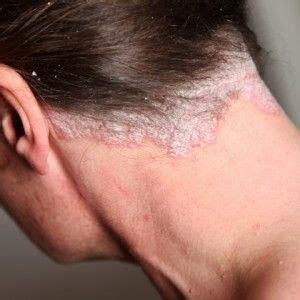 Diet For Scalp Psoriasis Home Remedies For Psoriasis, Natural Treatments, Laser Treatment ...