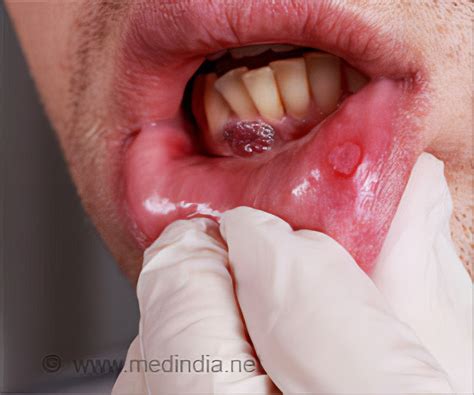 Oral Cancer Lip Images - Goimages Board