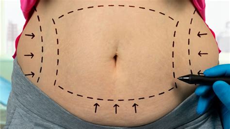 Liposuction: What to Expect During and After Recovery - Mid-Atlantic Skin Surgery Institute