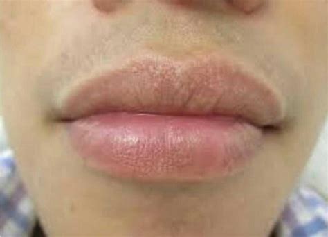 What Disease Causes Itchy Lips | Lipstutorial.org