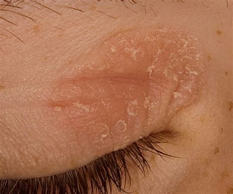 Eczema On Eyelid Symptoms Causes Pictures Treatment | Images and Photos ...