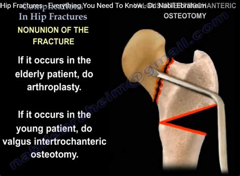 Hip Fracture complications — OrthopaedicPrinciples.com