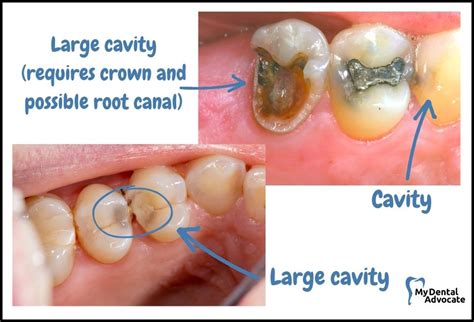 Cavities In Back Teeth