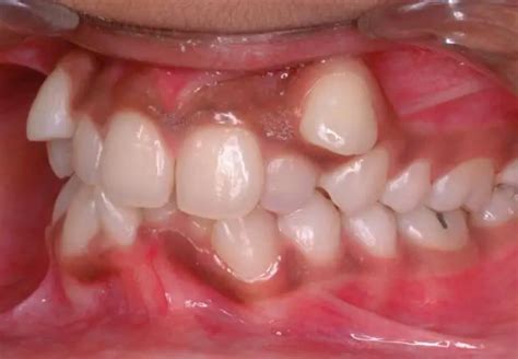 Malocclusion in a child: photo, causes, treatment | Dentistry 2024