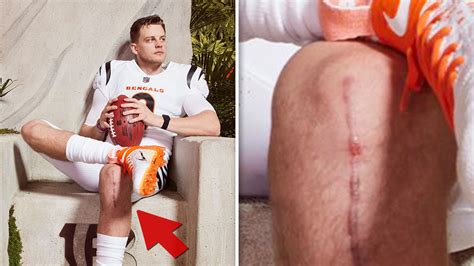 Joe Burrow's Huge, Gnarly ACL Surgery Scar Shown During Bengals' Jersey ...