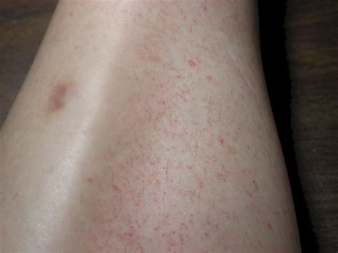 Small raised pinpoint red dots on skin not itchy - grosswh
