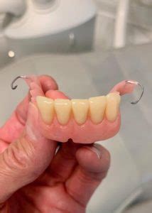 partial dentures-before/after | Dr. Gentry