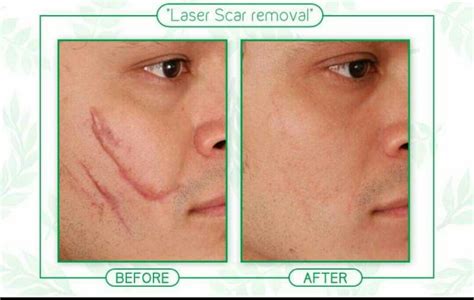 How much does laser Scar removal Cost in Nigeria? - Nigerian Health Blog