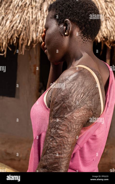 African woman burn victim covers her face while showing scars on her ...