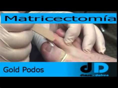 Matricectomía - YouTube