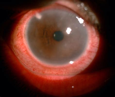 Corneal Edema Grading