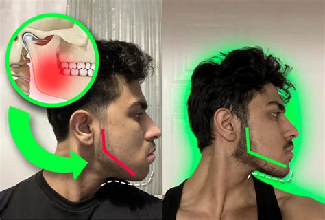 Jawline Sculpting Made Simple: 16 Ways To Get Sculpted Jawline | Mewing.coach