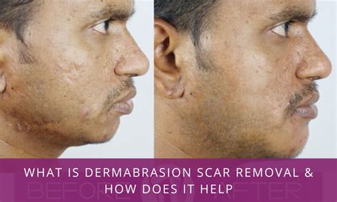 What is Dermabrasion Scar Removal & How Does It Help – Richardson's ...