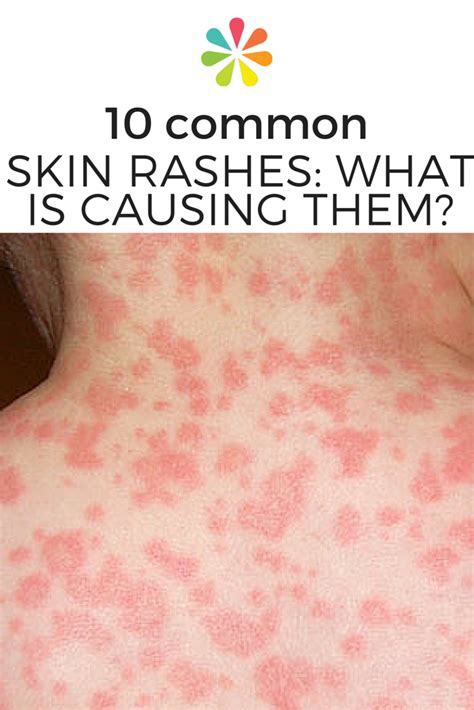 10 Most Common Types Of Skin Rashes Daily Health Valley | Images and Photos finder