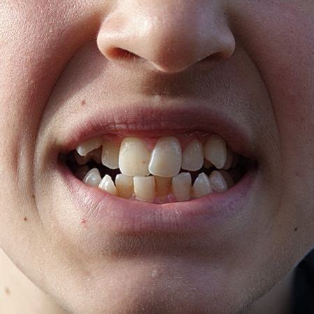 Overcrowded Teeth - Causes, Symptoms & How Best Treat Too Many Teeth!