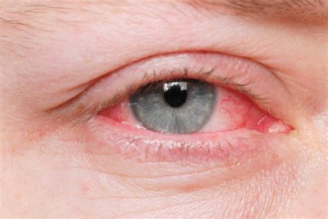 What Is Causing So Much Pink Eye? - Kowatek