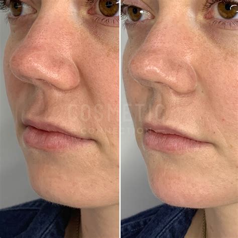 Nasolabial Fold Filler Sydney | Cosmetic Connection