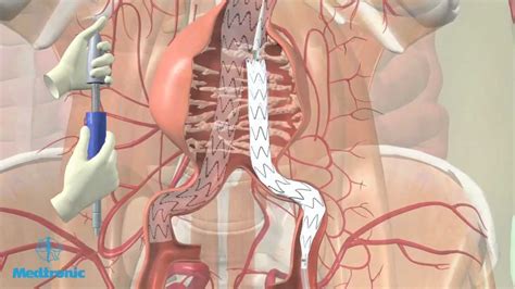 Operatie aneurysma van de buikslagader (EVAR-procedure) - YouTube