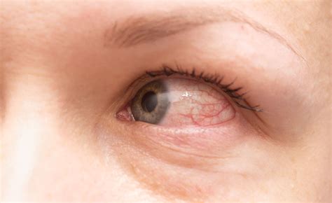 Allergy Symptoms - Camden Hills Eye Care