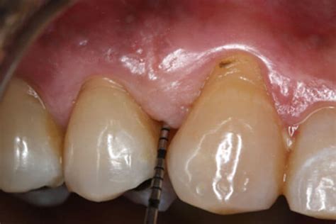 Stages of Periodontal Disease | Bayside Periodontics & Dental Implants