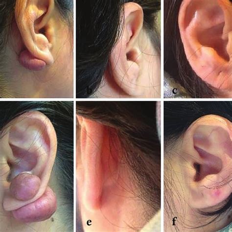 (PDF) Management of Ear Keloids Using Surgical Excision Combined with Postoperative Steroid ...