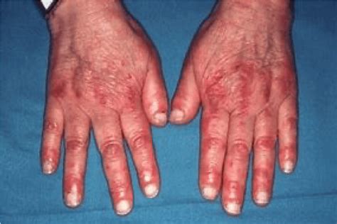 Dermatomyositis signs, symptoms: muscle inflammation & rash