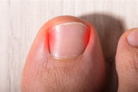 Ingrown Toenail Remedies You Can Do at Home - Podogo