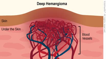 Infantile Hemangiomas (for Parents) - Johns Hopkins All Children's Hospital