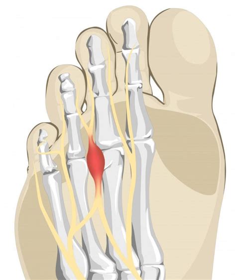 Mortons Neuroma, Symptoms, Causes and Treatment Options