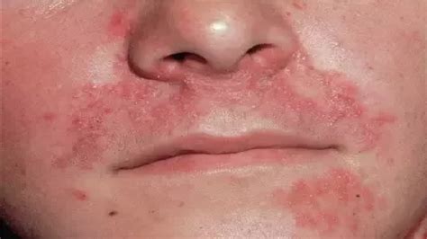 how to get rid of hives on your face - YouTube