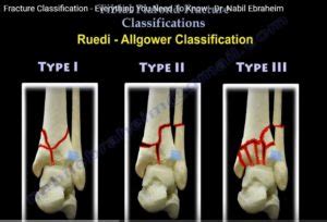 Tibial Plafond fracture Classification — OrthopaedicPrinciples.com