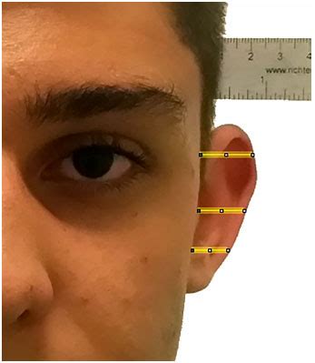 RBCP - Digital computerized analysis of auricle measures in otoplasties