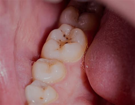 Black Stains On Teeth: Causes, Treatment And More – NatruSmile