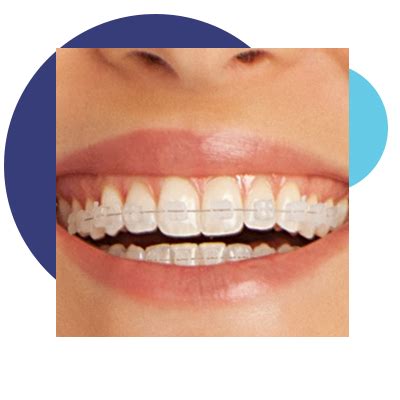 Braces in Myrtle Beach - Orthodontist | Munn and Becker Orthodontics-Myrtle Beach Orthodontics (MBO)