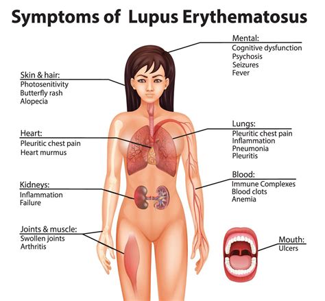 lupus-SLE-symptoms - Theayurveda