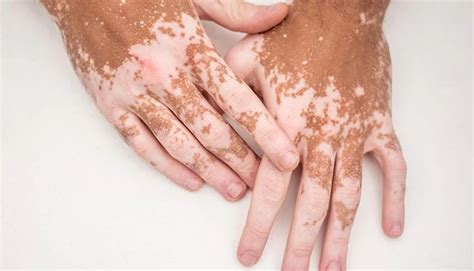 Vitiligo - Utah Valley Dermatology