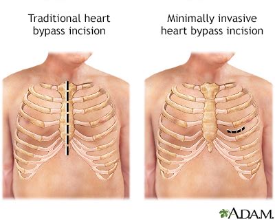 Heart bypass surgery Information | Mount Sinai - New York