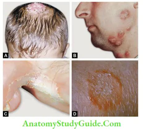 Fungal Infections: Symptoms, Types, And Treatment - Anatomy Study Guide