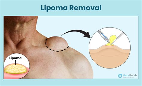 Lipoma Treatment: Removal Surgery, Procedure, and Pictures