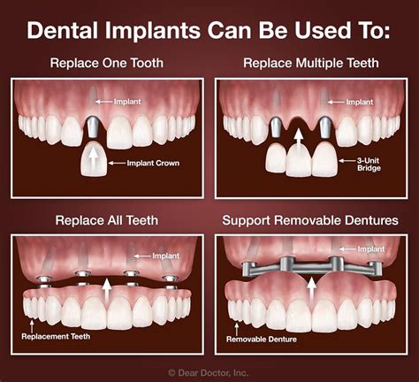 Frequently Asked Questions About Dental Implants | Evergreen Family ...