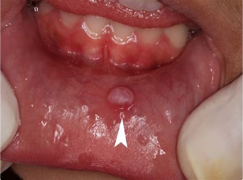 SciELO - Brasil - Schwannoma of the lower lip mimicking a mucocele in ...