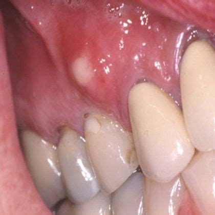 What is phoenix dental abscess? | News | Dentagama