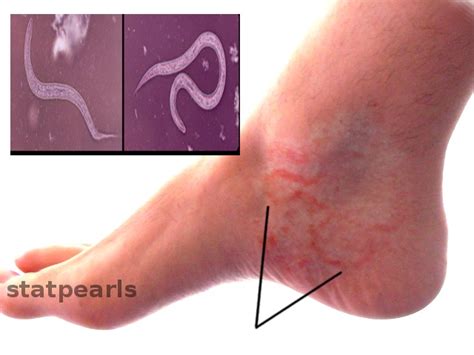 [Figure, Hookworm infection] - StatPearls - NCBI Bookshelf