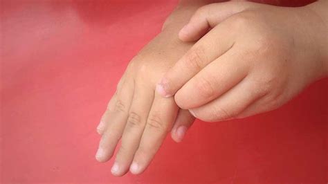 Videos: Eczema » Raffles Medical Group, Singapore